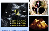 Doppler Echocardiography Hemodynamic Assessment