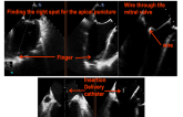 3D-Echocardiographic Guiding of a Novel Transcatheter Mitral Valve Replacement