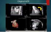 CT Assessment of the Aortic  Annulus for TAVR: What  Measurements are Important  and How to Obtain Them
