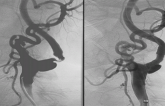Plaque Protrusion an Infrequent but Troubling Complication of Carotid Artery Stenting