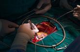 High-Volume Surgeons More Likely to Perform Durable Mitral Valve Repairs, Have Better Outcomes
