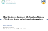 How to Assess Coronary Obstruction Risk on CT Prior to Aortic Valve-in-Valve Procedures