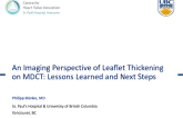 An Imaging Perspective of Leaflet Thickening on MDCT: Lessons Learned and Next Steps