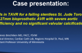 Pitfalls in TAVR for Failing Stentless St. Jude Toronto 27mm Bioprosthetic AVR With Severe Aortic Insufficiency and No Significant Valvular Calcification