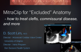 MitraClip for “Excluded” Anatomy: How to Treat Clefts, Commissural MR, and More