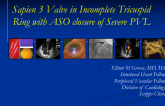 Tricuspid Sapien 3 Valve in Incomplete Ring Followed by ASO Closure of Severe PVL for Severe TR and Refractory Right Sided Heart Failure