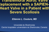 Transfemoral Aortic Valve Replacement With a SAPIEN-3 Heart Valve in a Patient With Severe Scoliosis: A Roller Coaster Ride