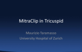 Tricuspid Technology 1: MitraClip for Tricuspid
