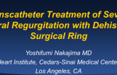 Transcatheter Treatment of Severe Mitral Regurgitation With Dehisced Surgical Ring