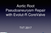 Aortic Root Pseudo-aneurysm Repair With Evolut-R CoreValve
