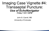 Imaging Case Vignette #4:Transseptal Puncture:Use of EchoNavigator