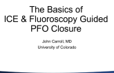 The Basics of ICE & Fluoroscopy GuidedPFO Closure