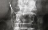 Inferior Vena Cava Filter Use Fell After FDA Warning but Remains High
