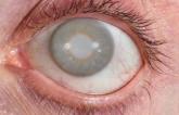 Study Warns Interventional Cardiologists of Heightened Cataract Risk