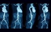 Incidental Findings on CT Angiography Predict All-Cause Mortality Following TAVR