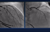 CABG vs PCI vs Mechanical Support