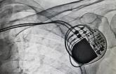 One in Four ICD Patients Need Reintervention Within 5 Years