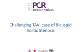 Challenging TAVI Case of Bicuspid Aortic Stenosis