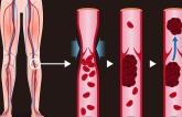 Apixaban May Be Better Choice Than Rivaroxaban for DVT Patients 