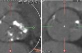 CT Scans Before and After TAVR Show Tricuspid, Bicuspid Valves Are Reassuringly Similar