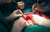 Multiarterial CABG Gets a Boost in Retrospective Analysis 