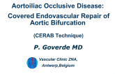 Aortoiliac Occlusive Disease: Covered Endovascular Repair of Aortic Bifurcations (CERAB Technique)