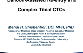 Case #4: Balloon-Assisted Re-entry in a Complex Tibial CTO (With Discussion)