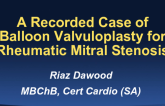 A Recorded Case of Balloon Valvuloplasty for Rheumatic Mitral Stenosis (With Integrated Discussion)