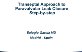 Case #8: Trans-septal Approach to Paravalvular Leak Closure - Step-by-step (With Discussion)