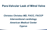 Cyprus Presents: Mitral Valve Paravalvular Leak Device Closure