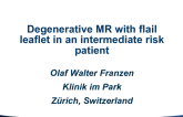 Case #3 Introduction: Degenerative MR With Flail Leaflet(S) in an Intermediate Clinical Risk Patient