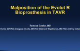 Malposition of the Evolut R Bioprosthesis During TAVR
