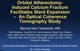 TCT 26: Orbital Atherectomy Induced Calcium Fracture Facilitates Stent Expansion - An Optical Coherence Tomography Study