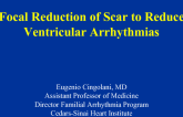 Focal Reduction of Scar to Reduce Ventricular Arrhythmias