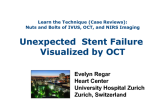 Case #8: Unexpected Stent Failure Visualized by OCT (With Discussion)