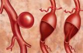 FDA Warns of Rising Endoleak Rates After Endovascular Aneurysm Repair
