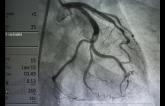 Angiography, Revascularization Safe in Acute MI Patients Taking OACs for Atrial Fibrillation