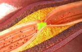Radial Access Best for PCI Following Thrombolysis in STEMI