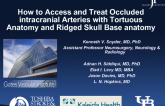 How to Access and Treat Occluded Intracranial Arteries With Tortuous Anatomy and Rigid Skull Base Arteries
