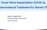 Transcatheter TR Solution 2: Caval Valve Implantation
