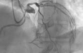 Patients Commonly Get High Radiation Doses During CTO PCI