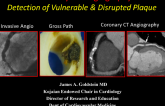 Current State-of-the-Art: Identification of Vulnerable Patients and Plaques With Noninvasive Testing