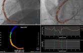 Quantitative Flow Ratio Shows Potential in Cath Lab