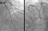PCI Comparable to CABG in Left Main Coronary Disease: Meta-analysis