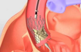 TAVR Tips and Tricks: How to Succeed with Challenging Cases