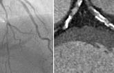 Myocardial Perfusion Imaging May Enhance CT-Based Evaluation of Stable Angina: CRESCENT II