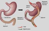 Bariatric Surgery: Cardiometabolic Benefits Down, but Not Out, at 5 Years