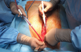 Largest Study to Date Supports Surgical LAA Closure in A-fib Patients
