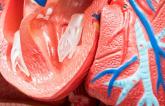 TAVR Outcomes Worse When the Right Ventricle Is Dysfunctional