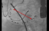 Edwards Voluntarily Recalls Cardioband ‘Anchors’ Used in Mitral and Tricuspid Repair